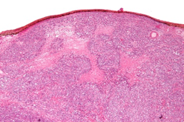 Figure 2: Small cell carcinoma of the ovary composed of diffusely disseminated small cells with scanty cytoplasm, uniform nuclei and miniature nucleoli impregnating the ovarian stroma which expounds focal fibrosis.