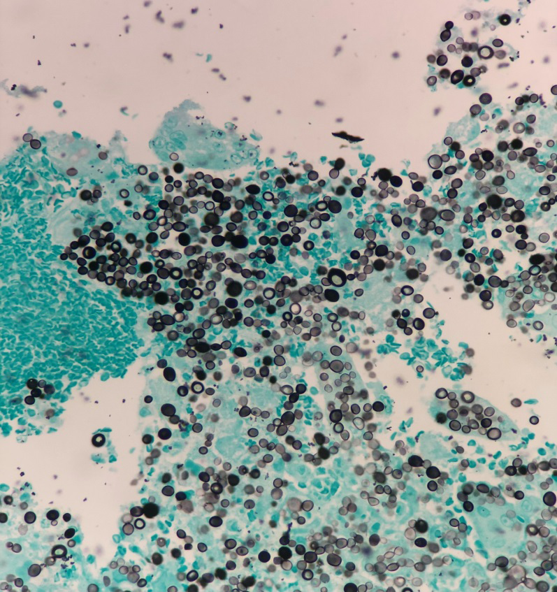 Figure 3: PAS stain highlighting thick-walled yeasts (magnification ×100).