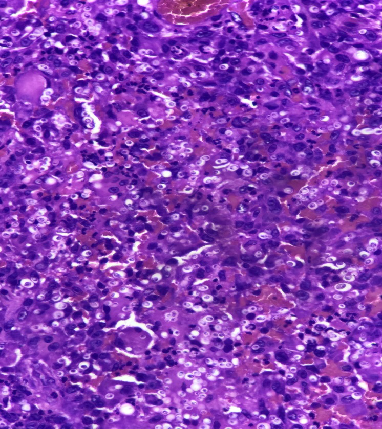Figure 4: GMS stain showing fungal elements (magnification} \times 200).