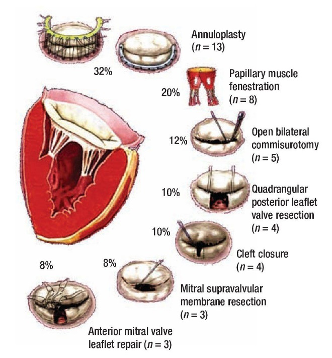 Figure 1: Mitral Valve Anatomy.
