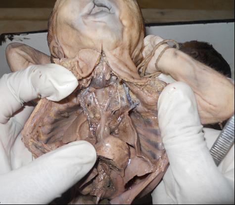 Figure 2: Twin-A with cleft lip showing heart and its anomalous vessels. Twin-B without Cleft Lip a. Here also origin of aorta and pulmonary artery were from single ventricle with incomplete spiral septum. Aortic arch gave rise to right brachiocephalic and left common carotid artery & left subclavian artery. b. Anomalies of systemic venous return were present.