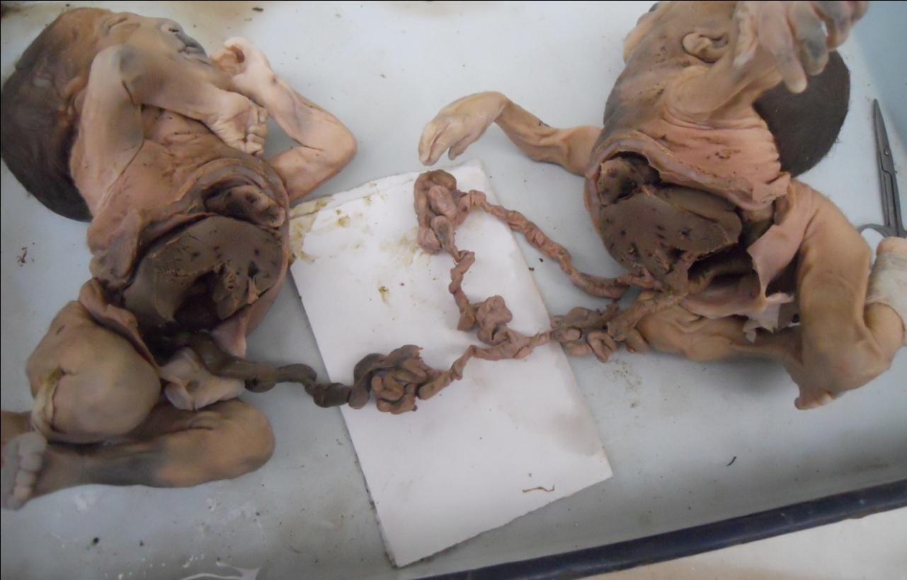 Figure 3: Two separated twins with separated liver and heart and common proximal ileum with separated appendix. There were two separate foreguts, one for each twin but union of duodenum at second part, forming a common terminal duodenum with single ampulla of vater receiving single common bile duct from two semi annular pancreases. Then there were common jejunum and common proximal ileum with its subsequent division into two terminal ileum for each twin and that is at the level of vitello-intestinal duct. So, from the level of vitello- intestinal duct, the rest of gut was separate for individual twin. Single common liver with fusion of anterior and posterior portions of porta-hepatis is much characteristic feature for the twins. The placenta was monoamniotic, monochorionic and weighted 280 gm. The umbilical cord extended from the abdominal region of the twins and inserted centrally on the foetal surface. There were total of five umbilical vessels, two veins and three arteries. One vein and one artery for twin-A, and two arteries and one vein from twin-B.