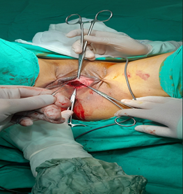 Figure 2: Patients were monitored for postoperative retention, frequent urination, feelings of urgency, pain, and dyspareunia. Possible complications were recorded.