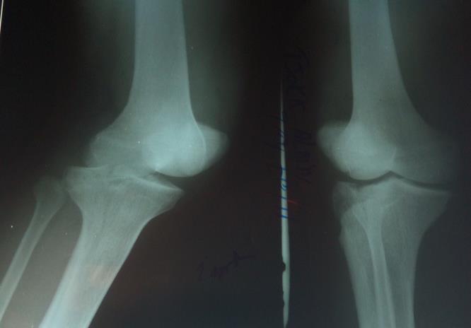 Figure 1: Aetiology of trauma. Therapeutic and prognostic profile: The average time lapse from incident to management in our series was 14.7 days and depended considerably on the stability of the patient’s financial income (Table1).