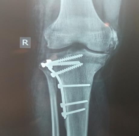 Figure 2: Fracture of the tibial plateau of the right knee Schatzker II (pre and post-operative pictures) stabilized by an upside-down AOL-shaped support plate.