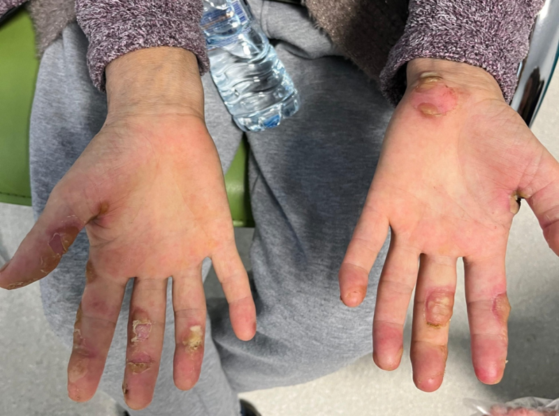 Figure 1: Erythematous callus-like hyperkeratotic nodules and bullae on her hands.