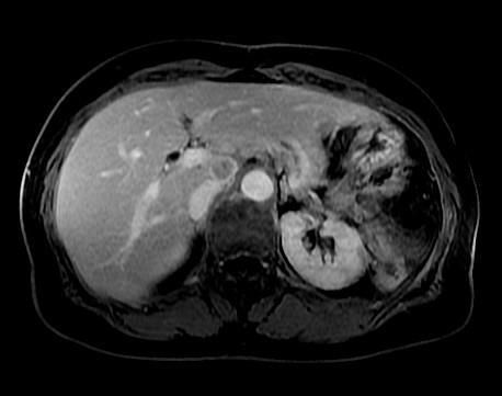 Figure 1: Preoperative liver MRI shows necroticliver lesion in segment VIII, suspicious of malignancy, with low signal on T1weighted sequences and T2, and restrictions on the diffusion, that retracts slightly the liver surface.