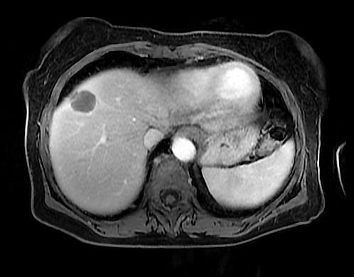 Figure 2: MRI of the liver showing the presence of a pathological hilar adenopathy of about 13 mm, suspicious of necrosis and with peripheral capsule effect, similar to the primary liver lesion. The analytical study showed thrombocytopenia 118,000 platelets/mm3, normal coagulation study, GOT 26 U/L, GPT 28 U/L, GGT, 30 U/L, Falc 75 U/L, BRB total 0.61 mg/dl; ferritin 275 mg/dl and Alpha fetoprotein 6.38 ng/ml. A biopsy of the hepatic lesion was scheduled, obtaining a cylinder of liver parenchyma with presence of cytokeratins suggestive of neoplasicnecrosis and without viable tumor cell population. The hepatic segment VIII, the gallbladder and adenopathies of the celiac trunk and the hepatic artery were resected. The immunohistochemical profile, of a cluster of lymph nodes located at the hepatic hilum and another adenopathy in the aortocavalinter-space, were consistent with nodal metastasis of poorly differentiated carcinoma compatible with HCC (Figure 3). It expressed cytokeratin AE1/AE3, 18 cam5.2, CK, CK 19 (focal), arginase deficiency (cytoplasmic droplets), AFP, Heppar-2 (focal), glypican-3 (focal) and TTF-1 (cytoplasmic). The lesion hepatic showed complete tumor necrosis with free surgical margins and the adjacent hepatic parenchyma showed a portal chronic hepatitis with minimal fibrosis.