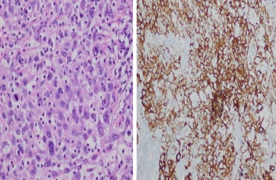 Figure 3: Histological and immunohistochemical analysis of lesions. Left panel shows the nodal metastasis of poorly differentiated hepatocellular carcinoma. Right panel, immunehistochemical stainings showing CK18 expression. Two months after the surgery, new focal lesions we’re not visible, in the liver by MRI, but at least two adenopathies of significant size had grown in the portacaval and retropancreatic space. Based on the evidence of progression and the recommendations of the experts to carry out a treatment similar to that of typical HCC, the patient was treated with the inhibitor of angiogenesis, Sorafenib. She developed a constitutional syndrome with poor control of hypertension and skin erythema on palms and soles, followed by painful erythroderma and desquamation of skin and/or development of bullous lesions, despite the reduction of sorafenib doses to half. After two months of intermittent treatment with poor tolerance, the treatment was suspended to include the patient in a clinical study for second-line therapy.