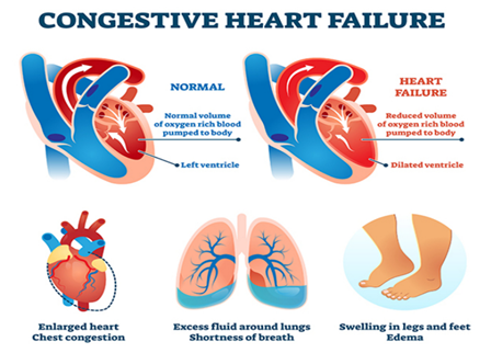 Figure 5: Difference between Normal Heart & Failured Heart.