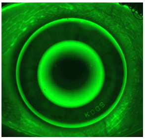Figure 3: An image captured of a modern orthokeratology lens on eye with sodium fluorescein instilled to show the different curves of the reverse geometry design lens.