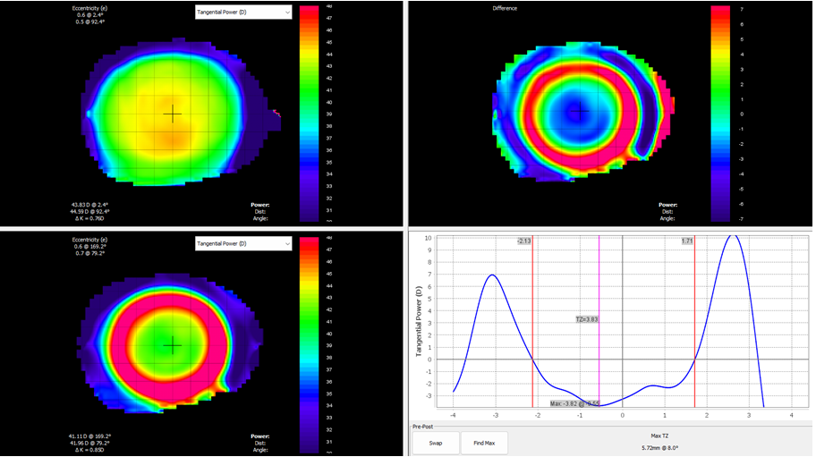 Figure 6: Tangential power difference map that describes instantaneous curvature of the cornea. The top left map is the pre-fitting map whilst the bottom left map is following orthokeratology lens wear. This shows where a lens has landed on the eye. Blue areas indicate flattening (bearing) whilst steep areas (reverse curve) are indicated in red. This does not show the refractive optics of the eye.