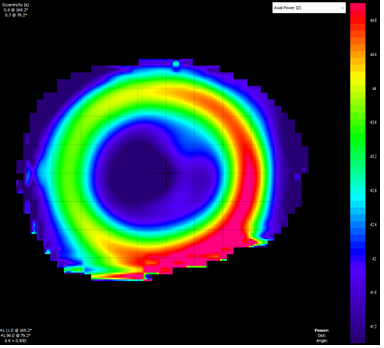 Figure 7: Axial power map following overnight orthokeratology wear. Red areas correspond to steepening of the cornea and blue areas correspond to epithelial thinning.