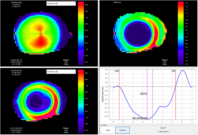 Figure 8: Axial power difference topography map of the eye shown in Figure 7. The axial power map shows the refractive optics on the eye.