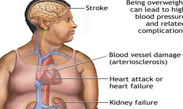 Figure 1: Complications of Obesity. Resulting Health Effects