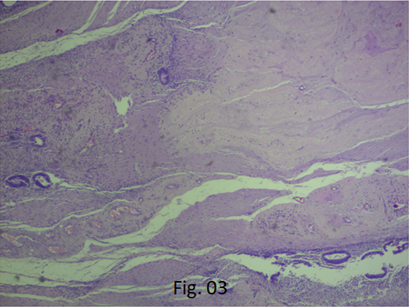Figure 3: Histopathological Image 40x Showing Jejunum with Extensive Mucosal Necrosis Extending up to the Muscularis. Submucosa Showing Dilated Vessels with Extensive Necroinflammatory Infiltrate Extending up to the Serosa. Also there is Intestinal Mucosal Wall Showing Islands of Endometrial Stroma and Glands.