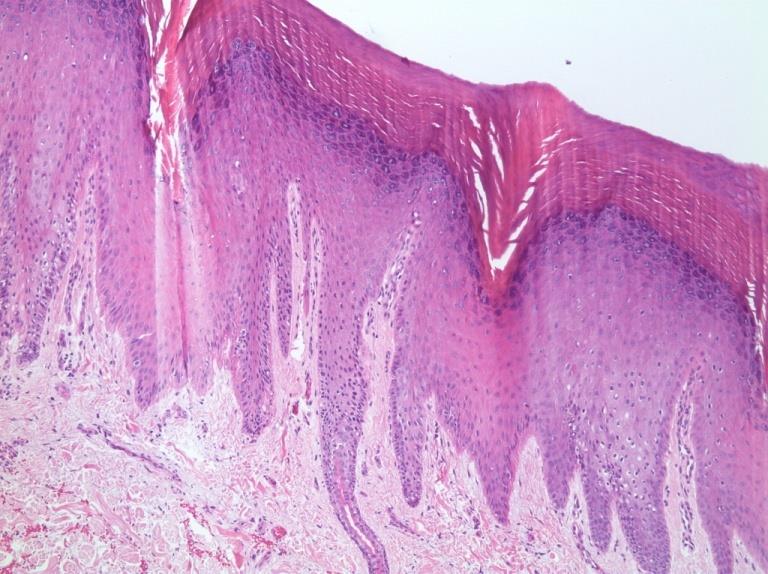 Figure 2: Punch biopsy from patient’s left palm consistent with keratoderma. Peripheral blood sample was collected. DNA extraction from the blood was performed using the QIAamp DNA blood midi kit from Qiagen (Cat No./ID: 51185) using the manufacturer's protocol. Exome sequencing was performed on the patient’s DNA to determine the molecular signature(s) underlying his condition. We used the exome capture method of the V6 Sure Select Kit from Agilent, and ran the libraries on a HiSeq4000 platform from Illumina at Macrogen-South Korea. We mapped the generated Fastq files to reference genome using the Burrows-Wheeler Alignment Tool (BWA). Using the Genome Analysis Tool Kit (GATK), insertions/deletions realignment and variant calling and filtering was conducted. Variant annotation was carried out using SnpEff and results were sent back in Excel sheet alongside the BAM and VCF files. The total read bases (bp) was within the 7 -7.8 X106 range. The average throughput depth of target regions was 128.5 with more than 70% coverage of >50X. Analysis was then conducted as follows: we first filtered the ~100 000 SNPs and Indels by eliminating the synonymous variants and variants in the non-coding regions of the genes to reach up around 12 000 SNPs and Indels. The latter were then filtered out again to keep only the variants with less than a Minor allele frequency of 10 % (MAF<10%).