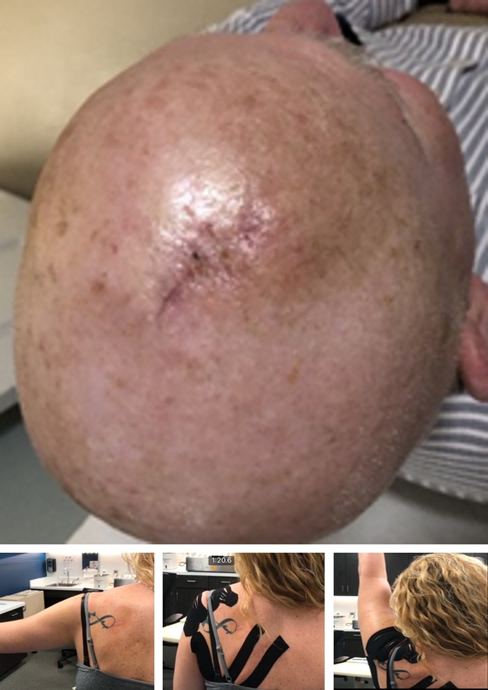 Figure 6: Accelerated wound healing with closure.