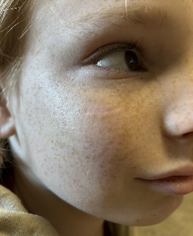 Figure 7: Wound healing after 4 weeks of therapy.