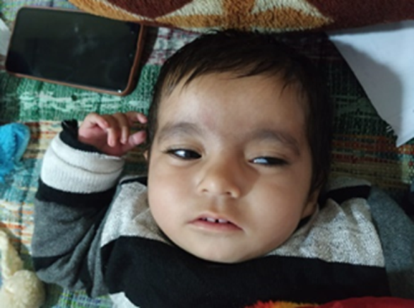 Figure 1: Facial Dysmorphism.