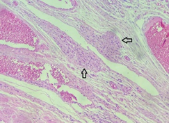 Figure 1: Stromal hyperplasia with hyperthecosis demonstrating foci of spindle shaped cells intermingled within collagen fibrils and follicular derivatives. Aggregates of polyhedral, luteinized theca cells appear imbued with eosinophilic cells.