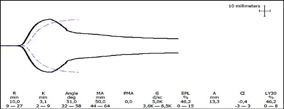 Figure 2: Clinical example of secondary hyperfibrinolysis on TEG. Note: D-Dimer – 700 µg/l.