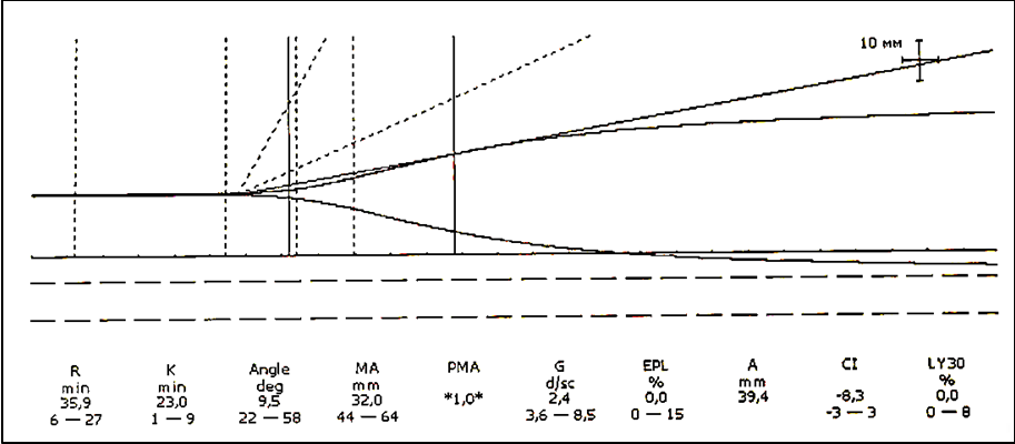 Figure 3: Clinical example of the development of the hypocoagulable phase of DIC on TEG (Platelets – 218 × 109/L; Hb – 129 g/L; Fibrinogen – 4.54 g/L; D-Dimer – 2500 µg/L).