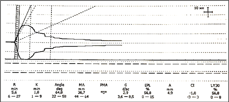 Figure 4: Clinical example of fibrinolysis activation during the transition from the hypercoagulable phase to the hypocoagulable phase of DIC on TEG (D-Dimer – 1150 µg/L, Antithrombin III – 75%).