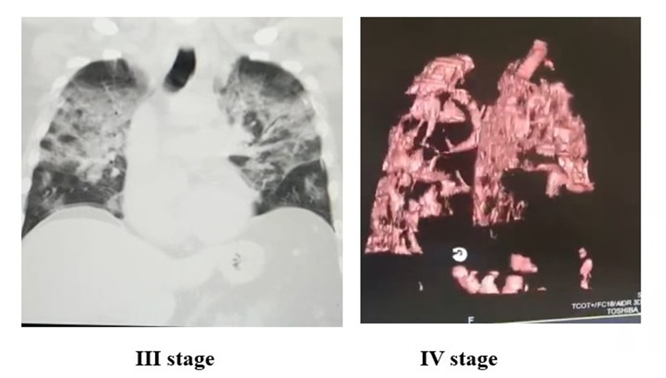 Figure 5: Radiological pattern in stage III and IV of ARDS
