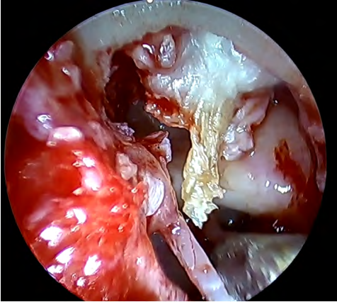 Figure 2: Otologic surgery was proposed to the patient due to the presence of cholesteatomatous tissue in an anatomically unfavorable ear because of the presence of the high jugular bulb. In this sense, the time of evolution of the disease, which was relatively short, had to be optimized in order to avoid progression of the tumor size and thus avoid a more aggressive approach that could damage the venous structure.