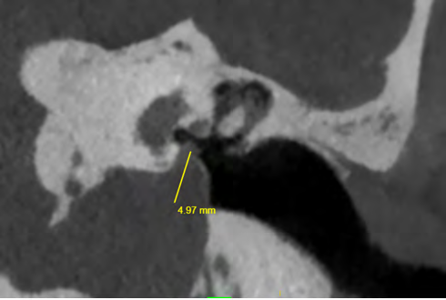 Figure 3: Endoscopic surgical view. High riding bulb in proximity with the incudo-stapedial joint. Left ear.