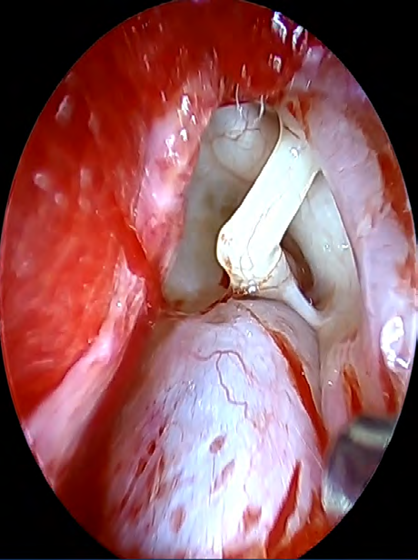 Figure 4: Attic cholesteatoma. Incus was removed, facial nerve and chorda tympani are shown.