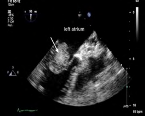 Figure 1: Showing left atrial myxoma.