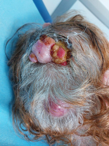 Figure 1: Proliferating trichilemmal cysts presenting as multiple nodular lesions in the parietal and occipital regions, with a smooth and keratinizing surface.