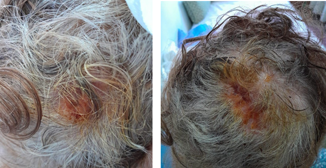 Figure 2: Post-operative result after complete excision of proliferating trichilemmal cysts.