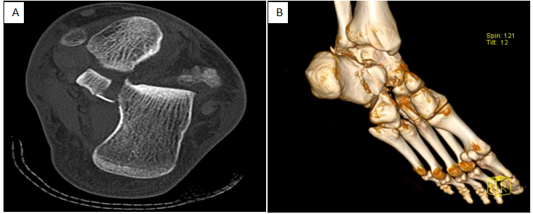 Figure 1: Axial view computed tomography scan showing comminuted fracture involving the calcaneus (A) Three-dimensional CT scan demonstrate sustentaculum tali fracture (B)