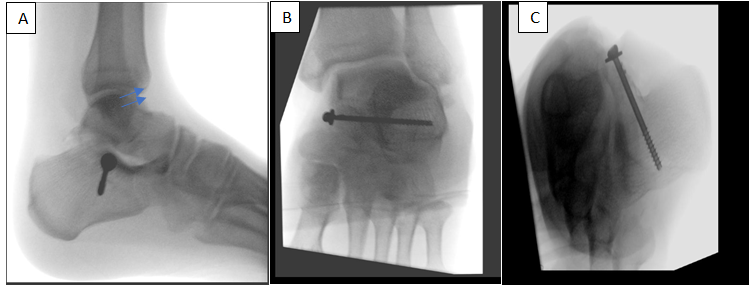 Figure 2: Fluoroscopy intra-operative.