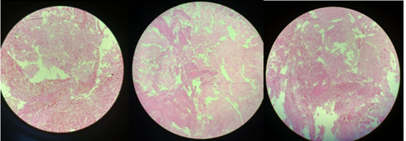 Figure 2: Histopathological Analysis of Pancreatic Cystic Lesion.
