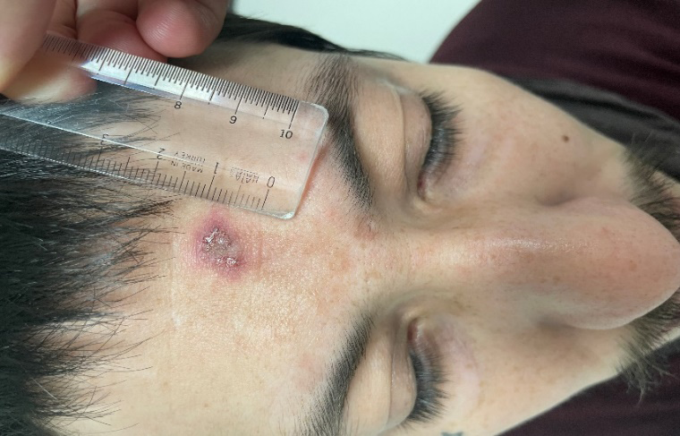 Figure 1: Lesion on the Frontal Midline of Case 1.
