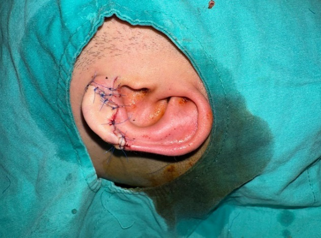 Figure 3: Sutured amputation with early intervention.
