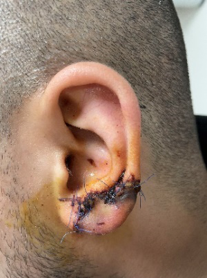 Figure 4: The amputated part that started to necrosis 1 day after the incident and the ear with an infective appearance.