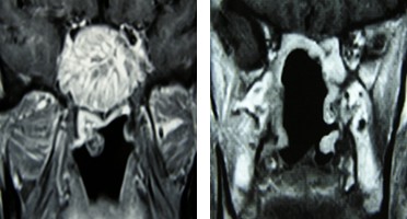 Figure 1: Magnetic resonance coronal sections. A: inverted papilloma of sphenoid sinus. B: 45 days postoperatively, a tumor infiltrating the left cavernous sinus is observed (red arrow).