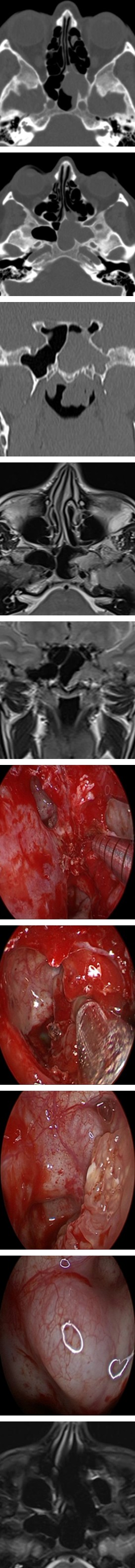 Figure 2: Inverted papilloma of the sphenoid sinus with implantation in the carotid artery.