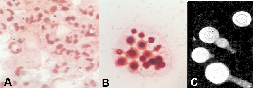Figure 3: Cellular analysis of cerebrospinal fluid.