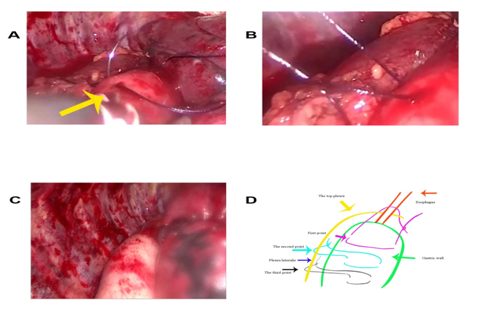 Figure 2: A:Completion phase of the second suspension point, demonstrating final muscular layer approximation along the greater curvature using the third suture needle. B: Finalized three-suture configuration at the secondary suspension point, showing optimal tissue apposition and tension distribution. C: Post-procedural morphology of the preserved tubular gastric conduit following complete three-point suspension implementation. D: Comprehensive schematic of the tripartite suspension system: Purple arrow - Primary the cupula of pleura fixation point; Dark green arrow - Secondary gastric body suspension; Black arrow - Tertiary greater curvature stabilization.