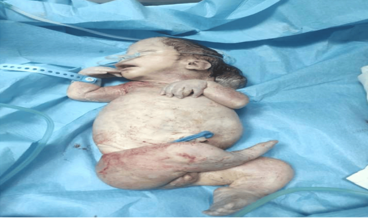 Figure 4: General appearance with abdominal distension, club feet and curved humerus.
