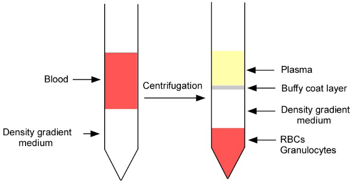 Figure 4: Isolation of Peripheral Blood Mononuclear Cells (PBMCs) from blood sample Identification of B-cells After isolating the PBMCs from breast tumour patients as well as healthy individuals, we check B-cells using flow- cytometry.