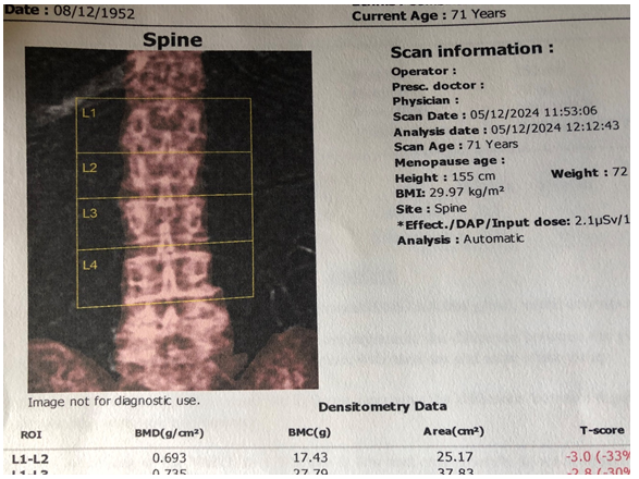Figure 1: Signs of Osteoporosis in spine.