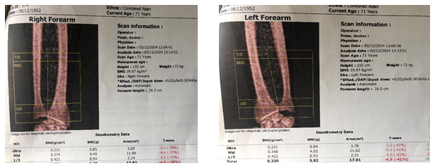 Figure 3: Signs of Osteoporosis in Right Forearm & Left Forearm.