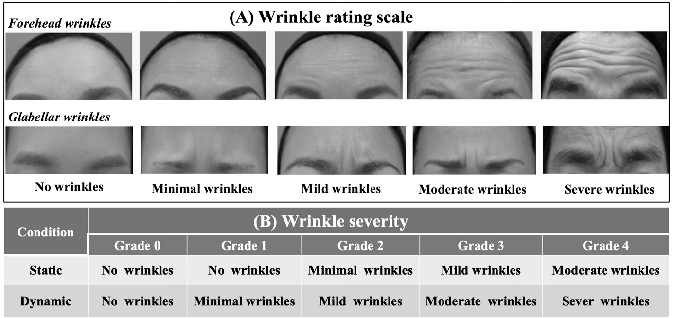 Figure 2: Wrinkle severity assessment. The degrees of the forehead and glabellar wrinkles observed in static and dynamic conditions for each patient were classified into five scales according to the wrinkle rating scale (A). The severity of wrinkles for each patient was finally graded into five levels from 0 to 4 by the combination of static and dynamic wrinkle severity (B).